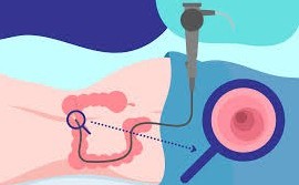 Learn about colonoscopy